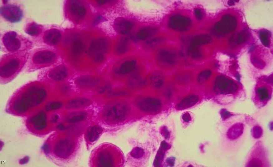 اكتشاف الخديعة الكبرى للخلايا السرطانية