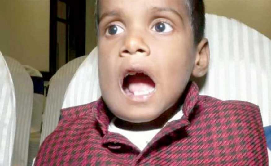 إزالة 526 سناً من فم طفل هندي!‏